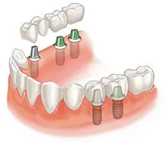 Multiple dental implants graphic