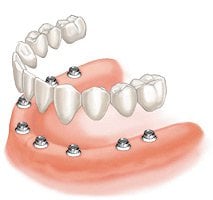 Teeth-in-a-Day graphic
