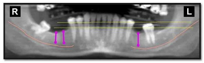 x-ray of a lower jaw with dental implants