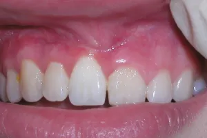 Esthetic Contouring before photo