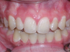 Esthetic Contouring after photo