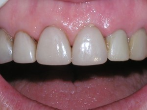 Dental Implant after photo