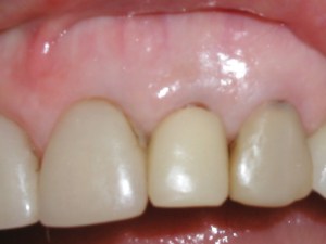 Dental Implant before photo