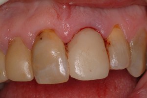 Dental Implant before photo