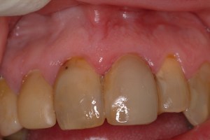 Dental Implant after photo