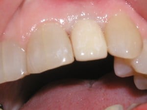 Dental Implants after photo
