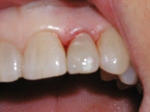 Dental Implants before photo