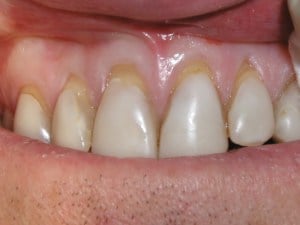 Soft Tissue Grafting before photo