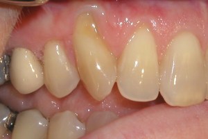 Soft Tissue Grafting before photo