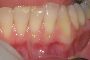 Soft Tissue Grafting before photo