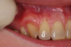 Soft Tissue Grafting after photo