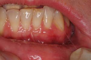 Soft Tissue Grafting after photo