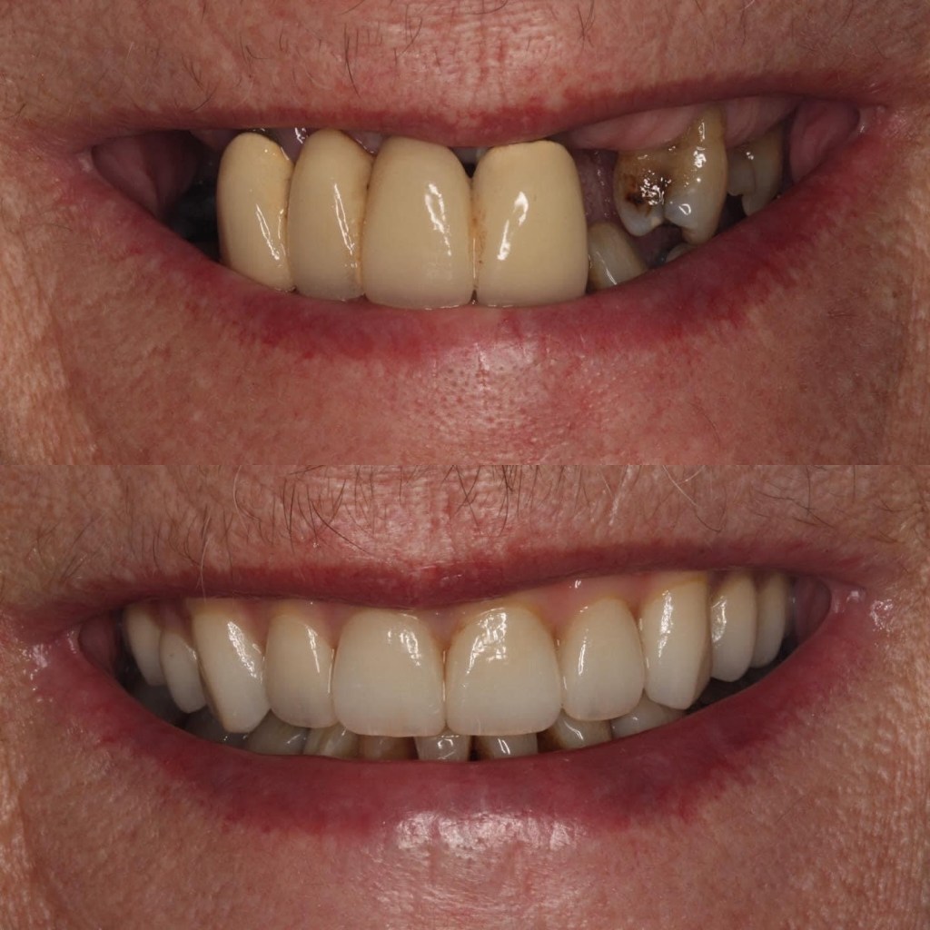 Dental Implants before and after photo