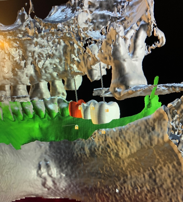 CAD-CAM program for designing tooth replacements