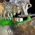 CAD-CAM program for designing tooth replacements