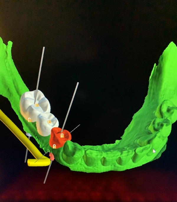 CAD-CAM program for designing tooth replacements