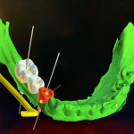 CAD-CAM program for designing tooth replacements