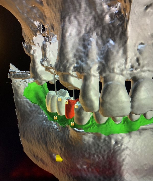 CAD-CAM program for designing tooth replacements