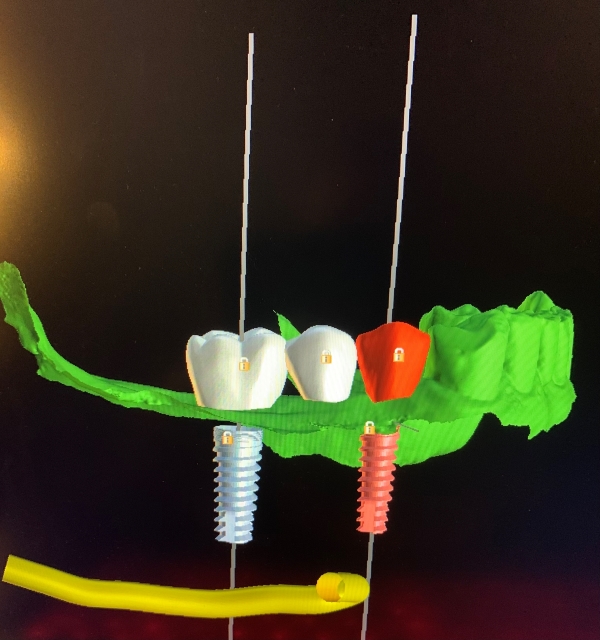 CAD-CAM program for designing tooth replacements