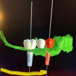 CAD-CAM program for designing tooth replacements